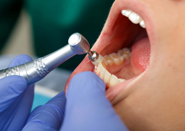 親知らず周辺の歯茎が腫れないように定期的に歯科医院で歯のクリーニングを受けるイメージ