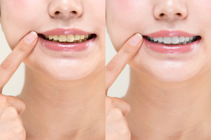 ホワイトニングのイメージ