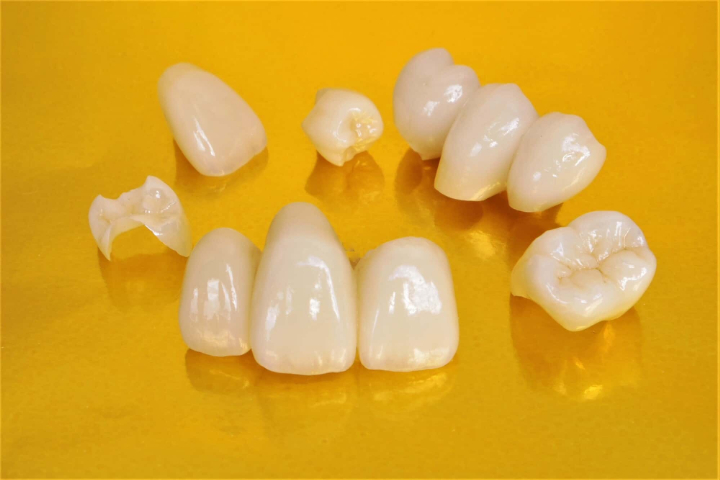 セラミック素材のインレーやクラウン