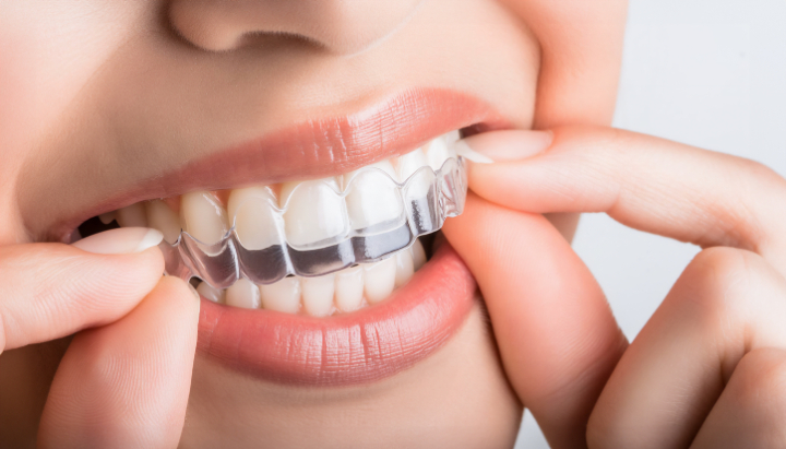 インビザラインを装着する様子