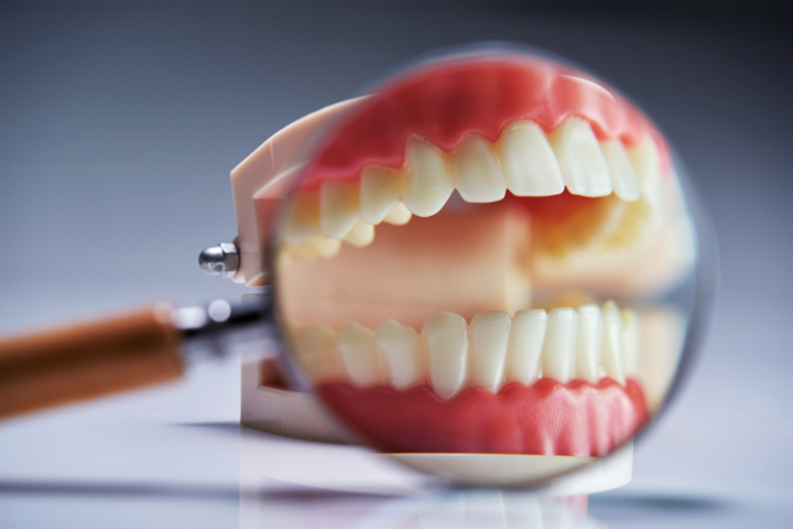 歯と歯の間にできる虫歯の特徴を見るイメージ