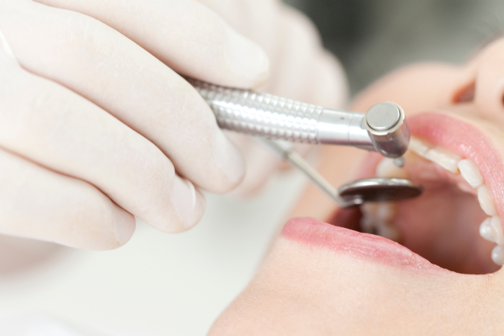 セラミック治療のために歯を削る様子