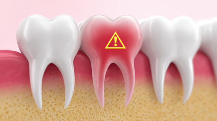 赤くなって注意マークがついているセラミックの奥歯の模型