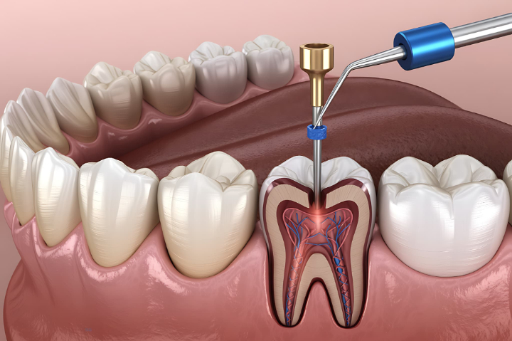 根管治療のイメージ