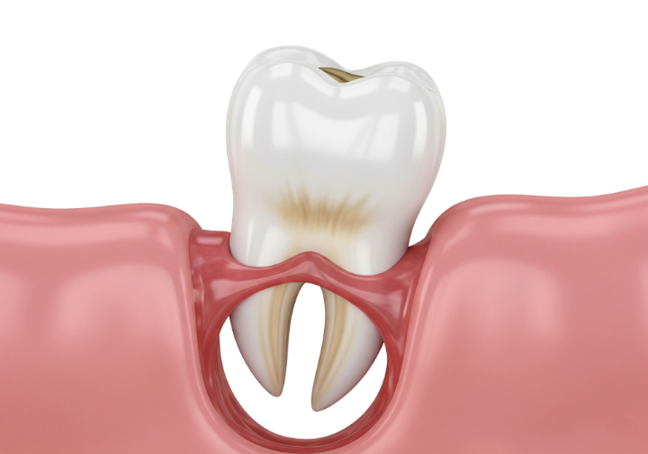 歯周病が進行して歯がぐらつく様子
