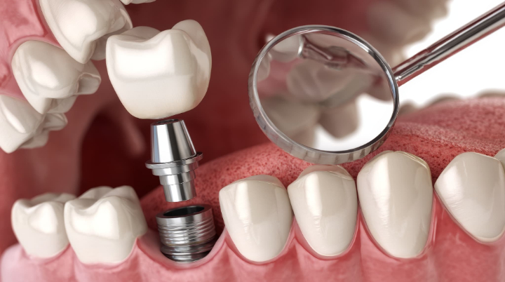 奥歯をインプラントにしているイメージ