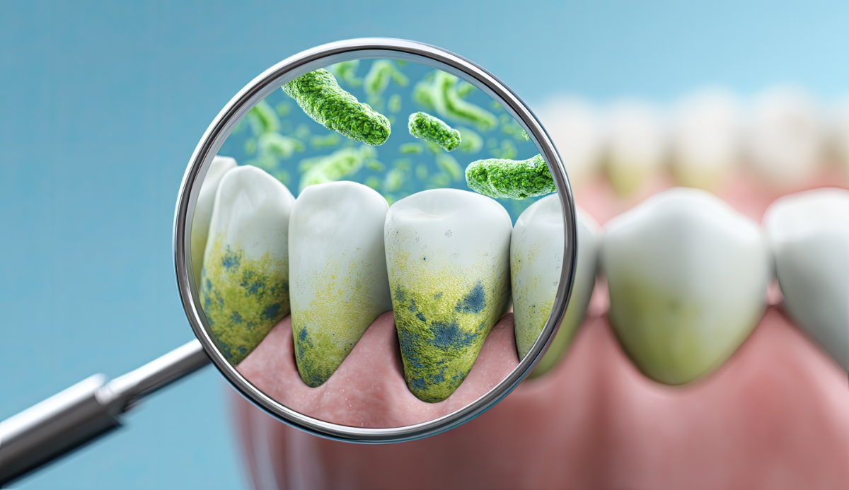 プラークと繁殖している細菌を虫眼鏡で拡大しているイメージ